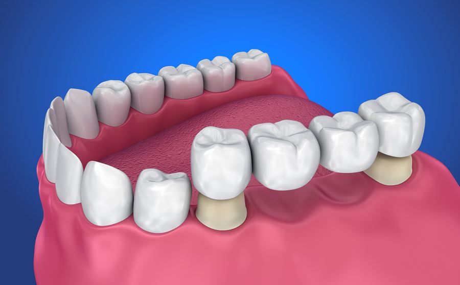 dental bridge repair durban