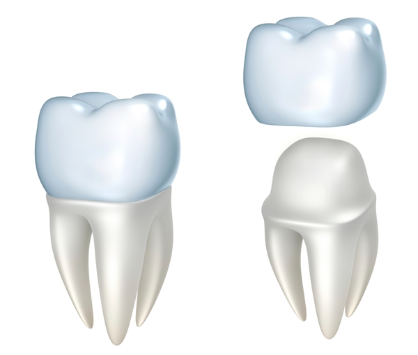 dental crown durban