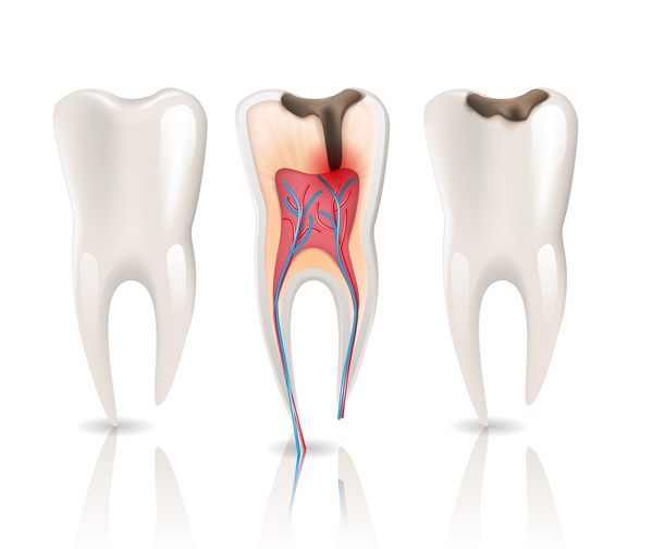 endodontics rootr canal durban