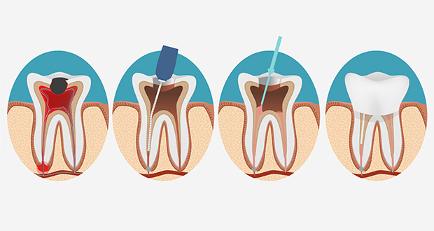 root canal repair durban