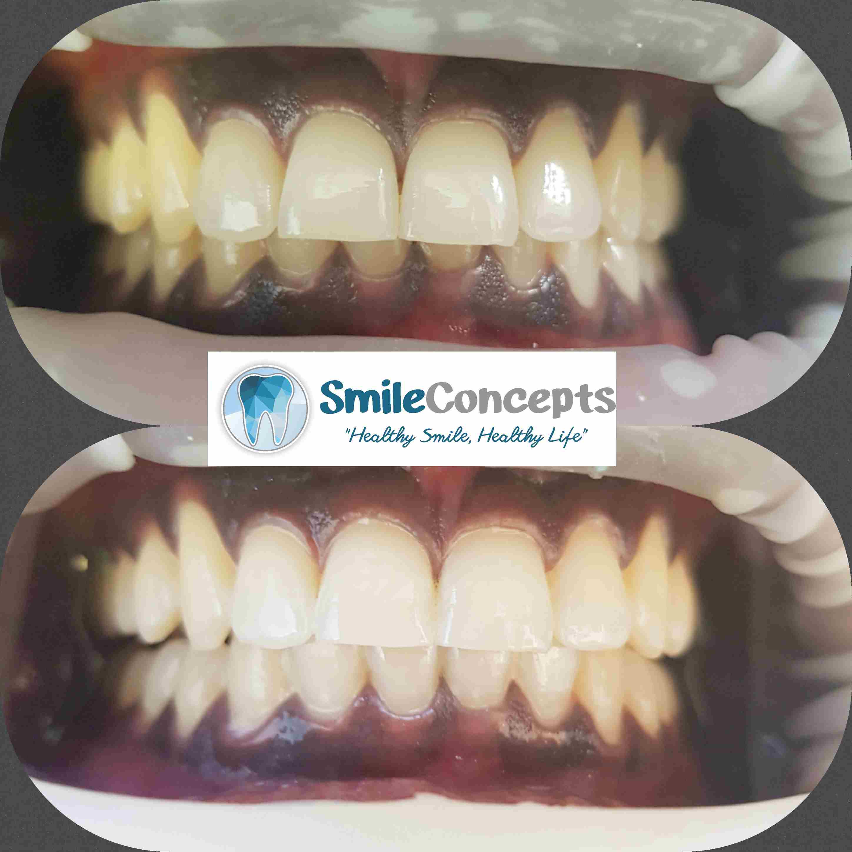 teeth whitening durban